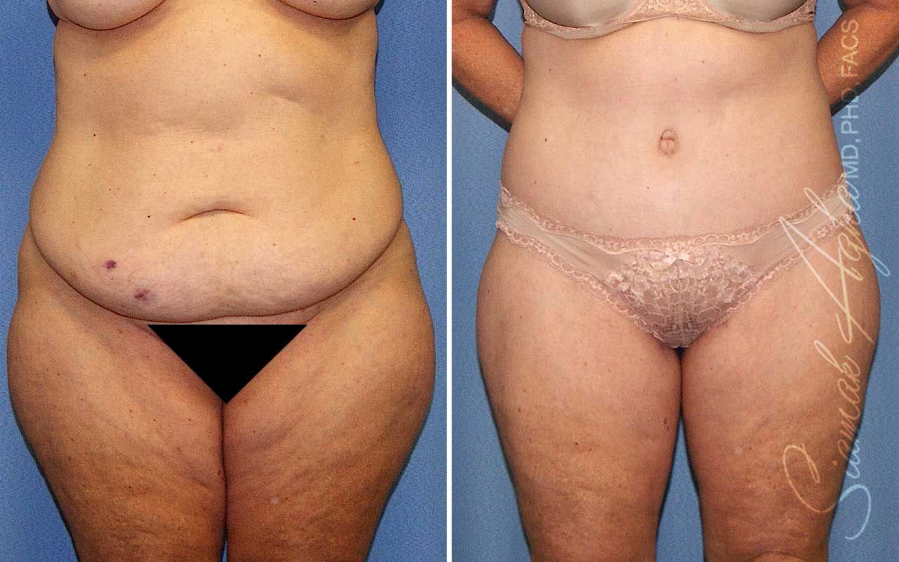 Lower Body Lift Before & After