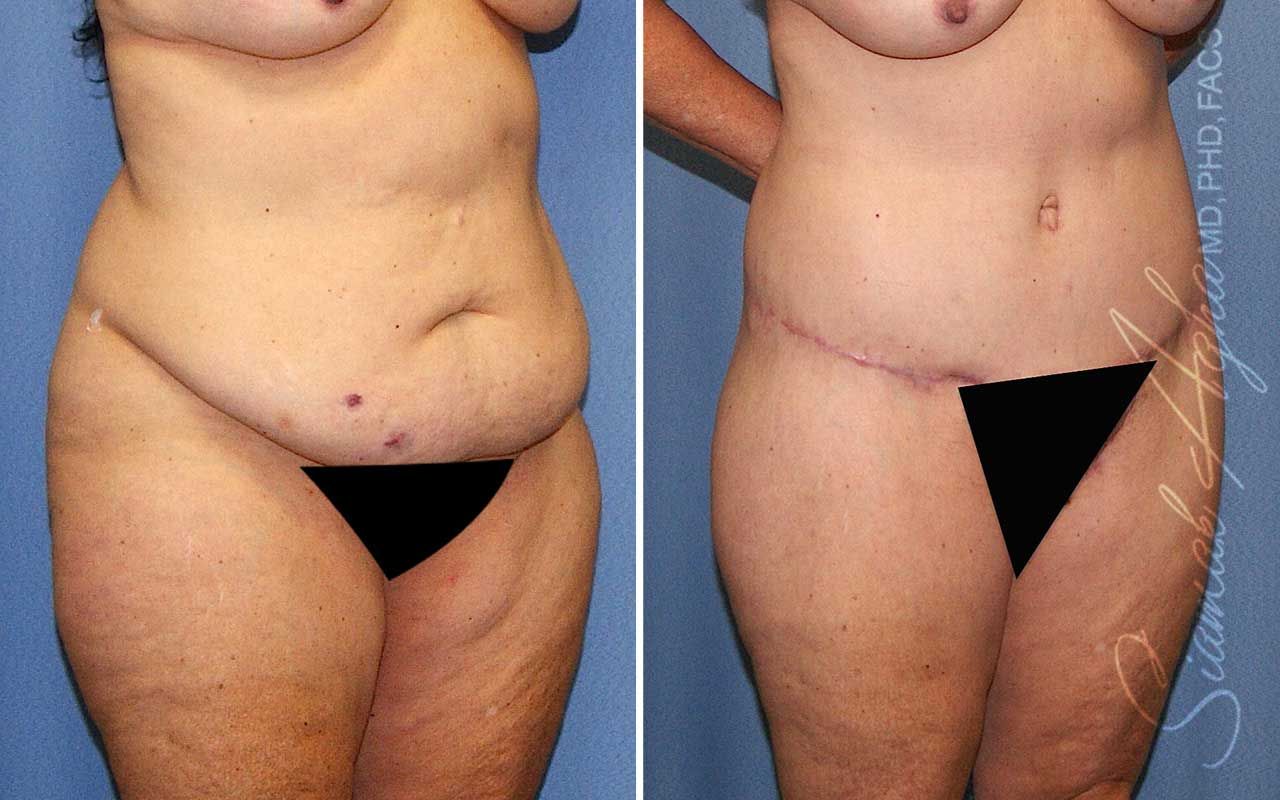 Lower Body Lift Before & After