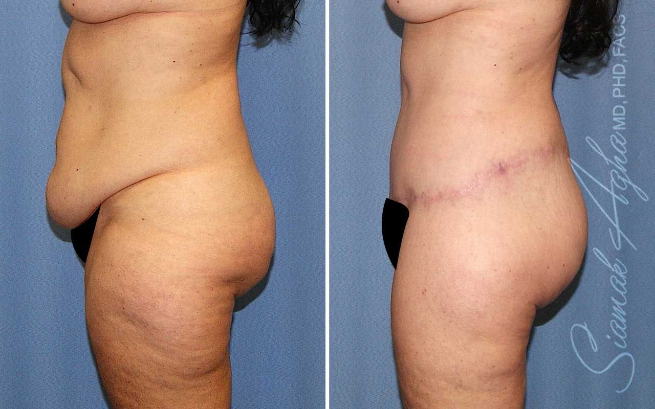 Lower Body Lift Before & After