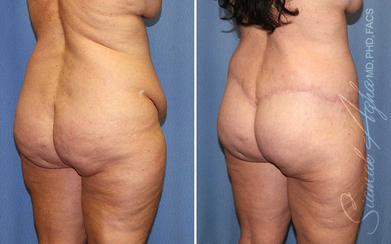 Lower Body Lift Before & After