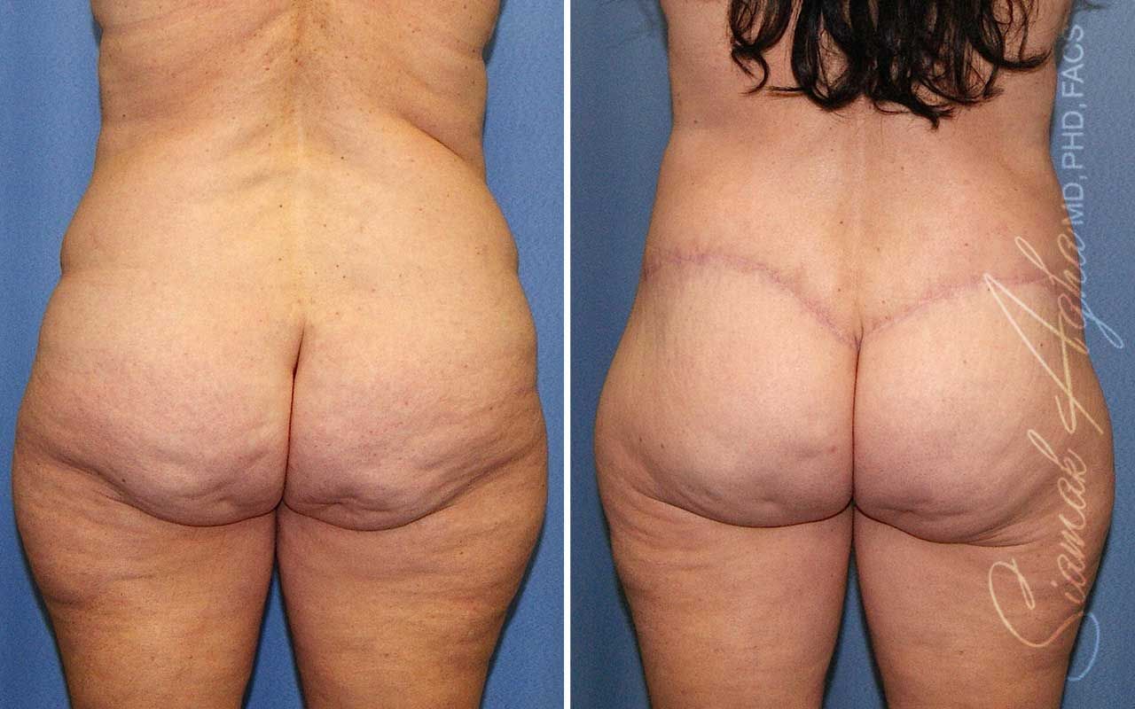 Lower Body Lift Before & After