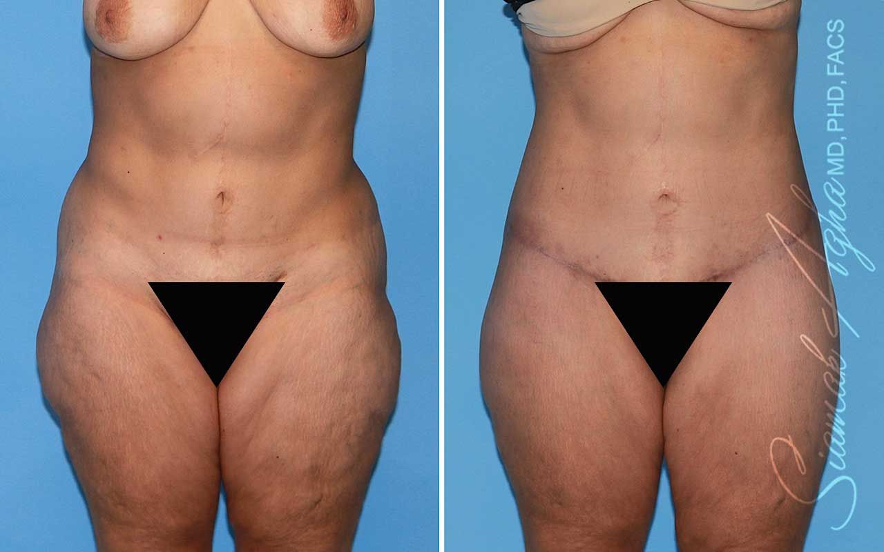 Lower Body Lift Before & After