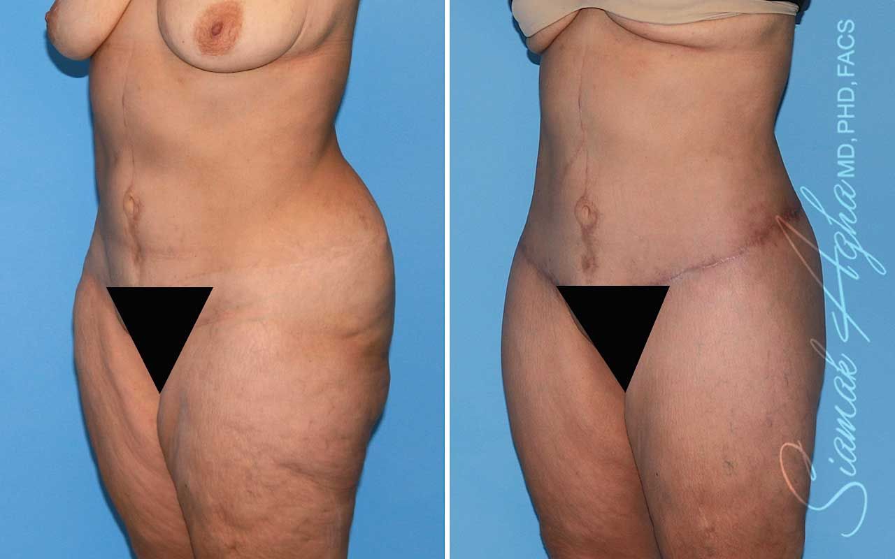 Lower Body Lift Before & After