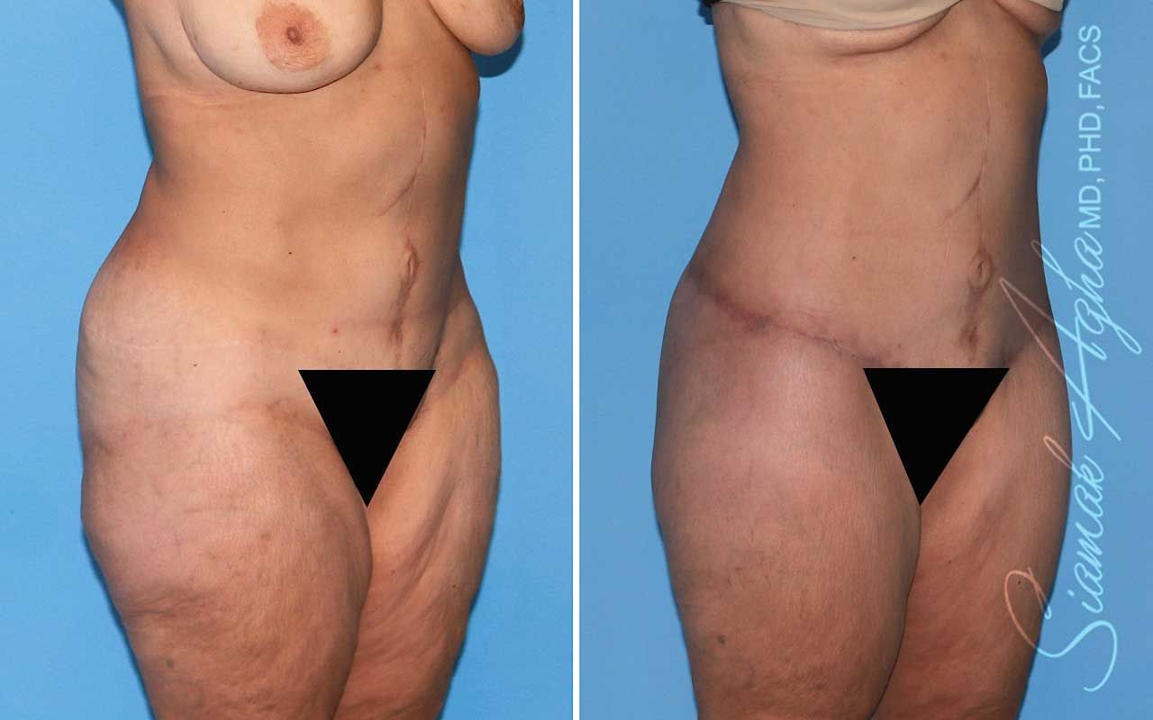 Lower Body Lift Before & After