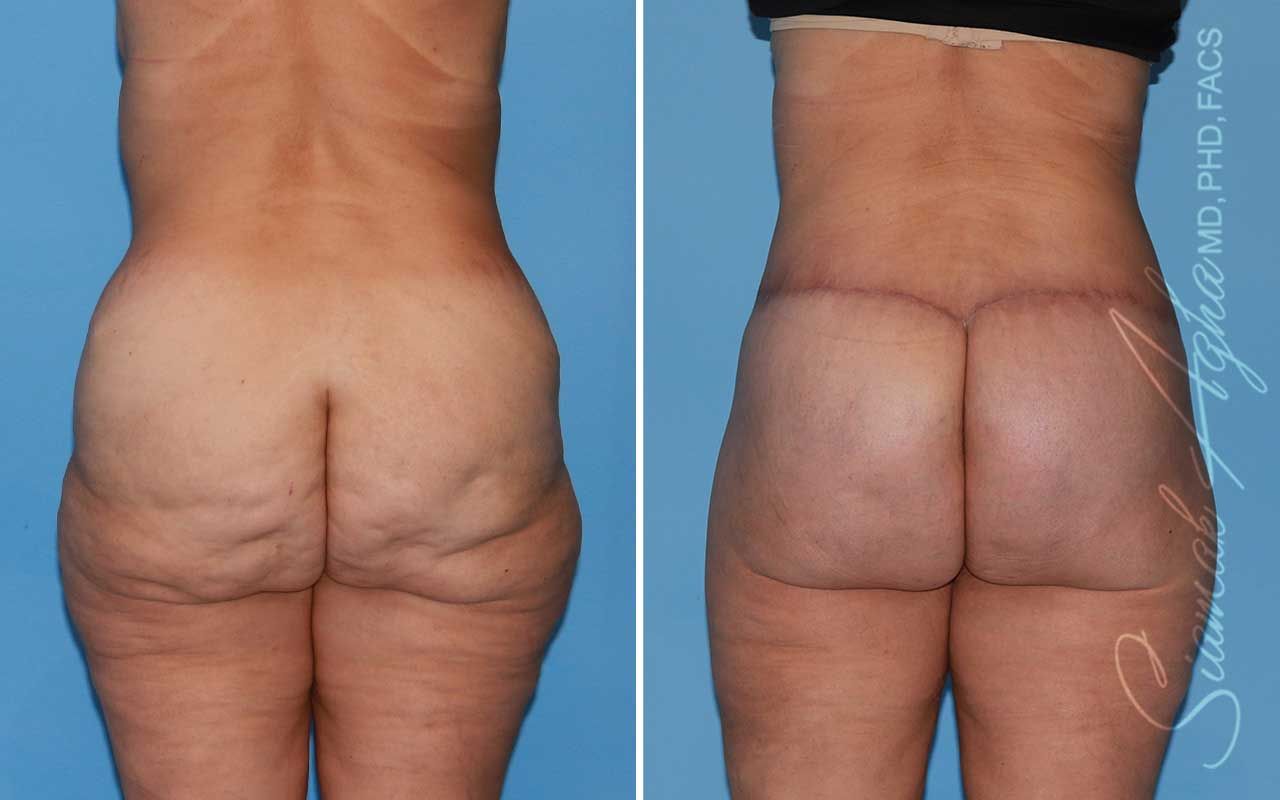 Lower Body Lift Before & After
