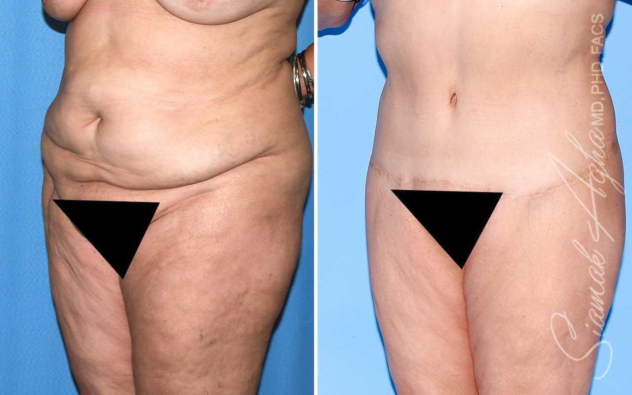 Lower Body Lift Before & After