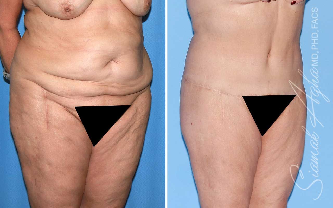 Lower Body Lift Before & After