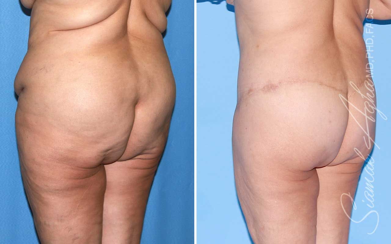 Lower Body Lift Before & After