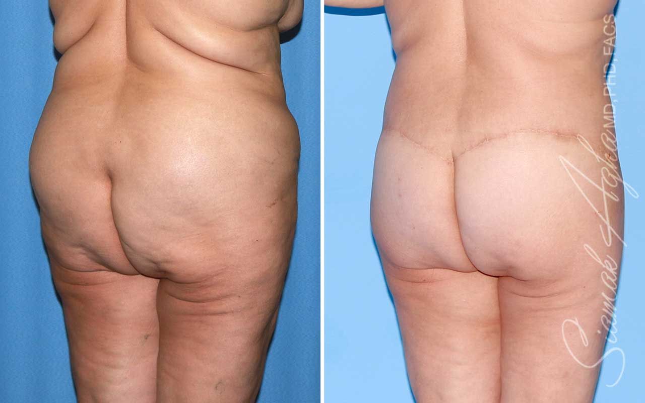 Lower Body Lift Before & After
