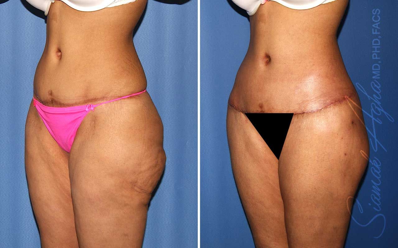 Lower Body Lift Before & After
