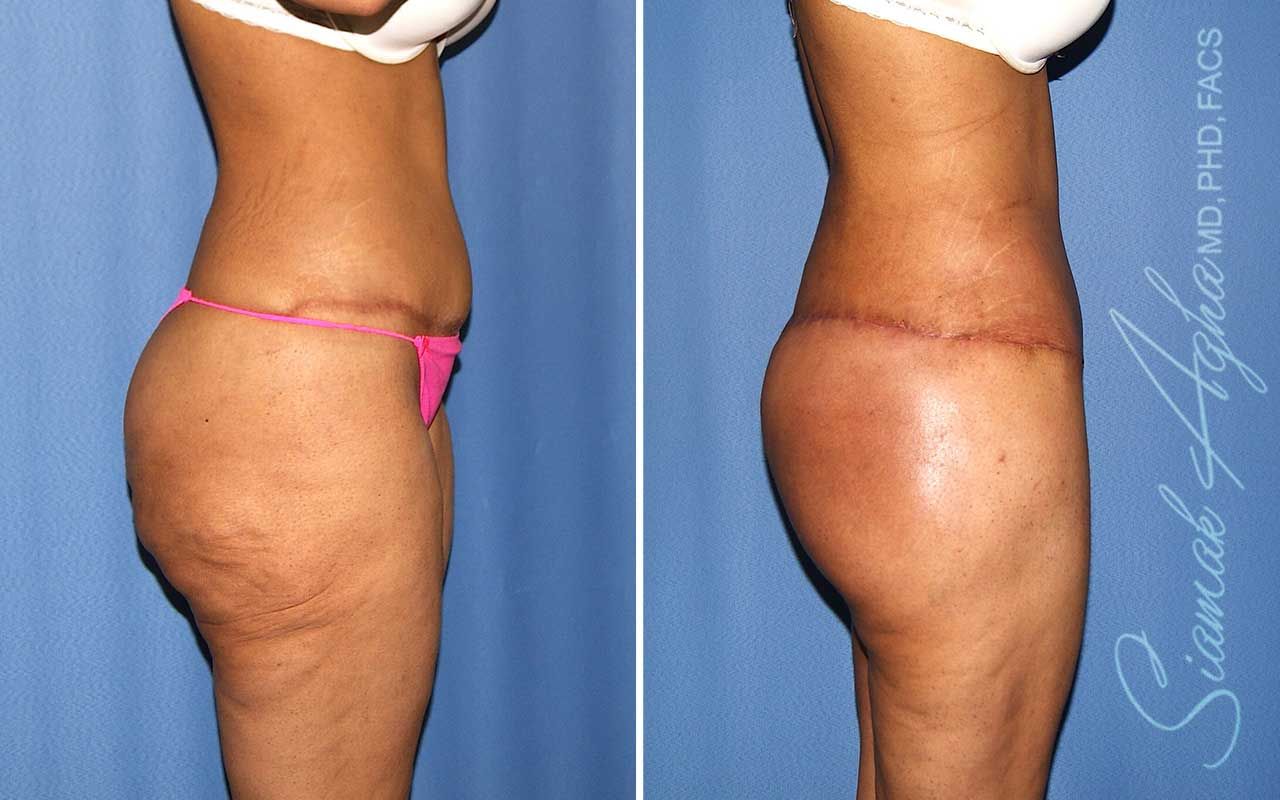 Lower Body Lift Before & After