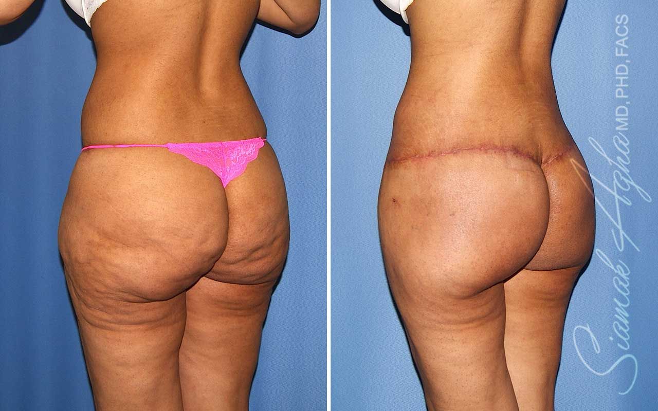 Lower Body Lift Before & After