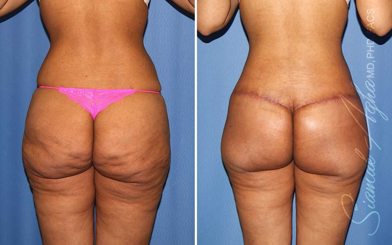 Lower Body Lift Before & After
