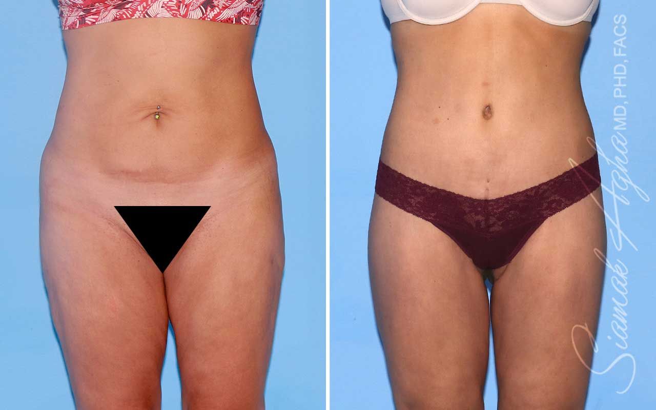Lower Body Lift Before & After