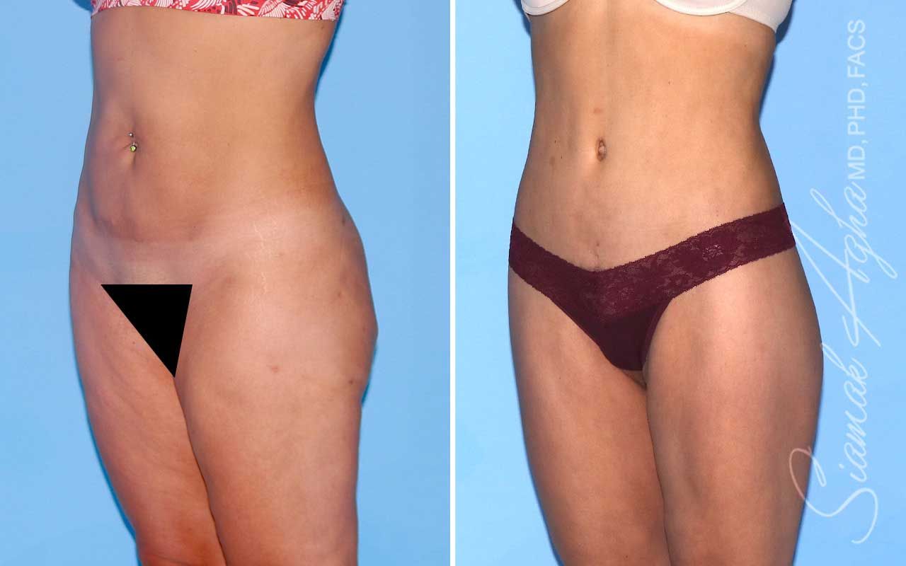 Lower Body Lift Before & After