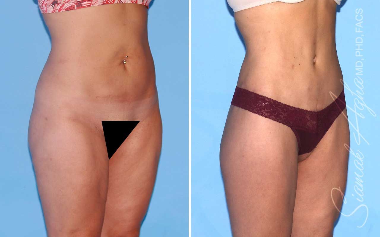 Lower Body Lift Before & After
