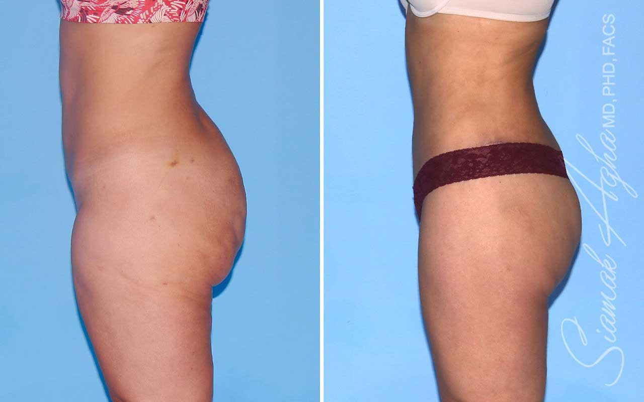 Lower Body Lift Before & After