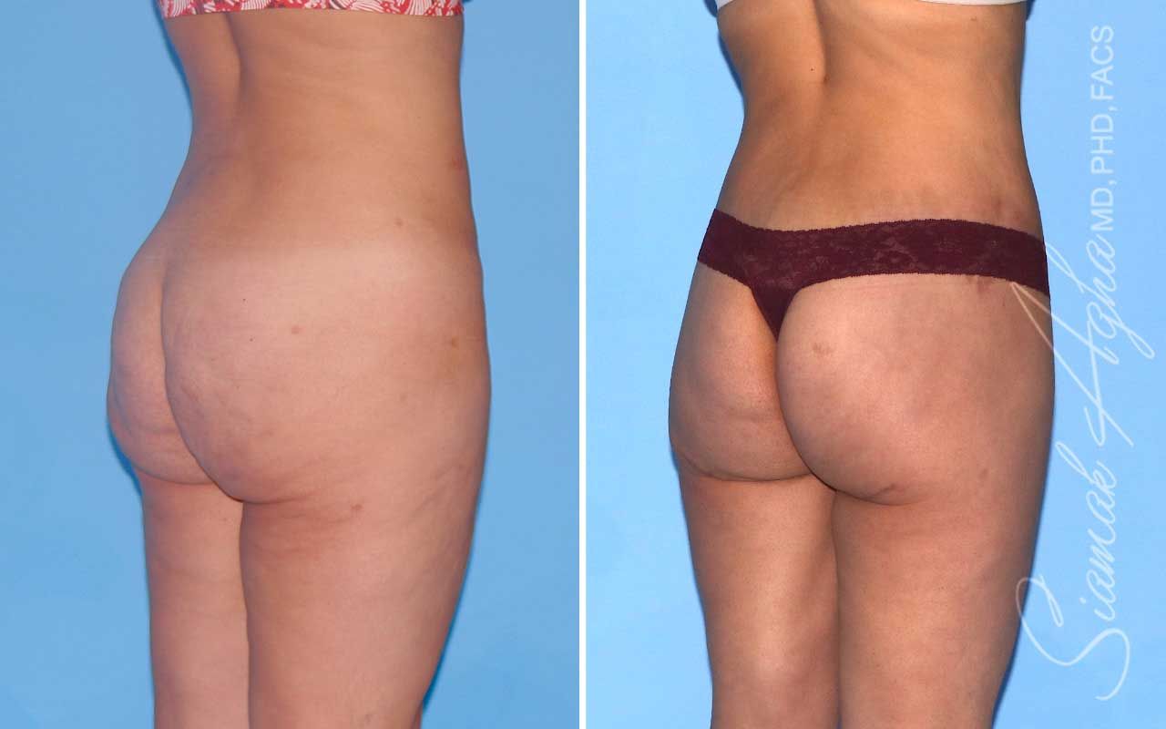 Lower Body Lift Before & After