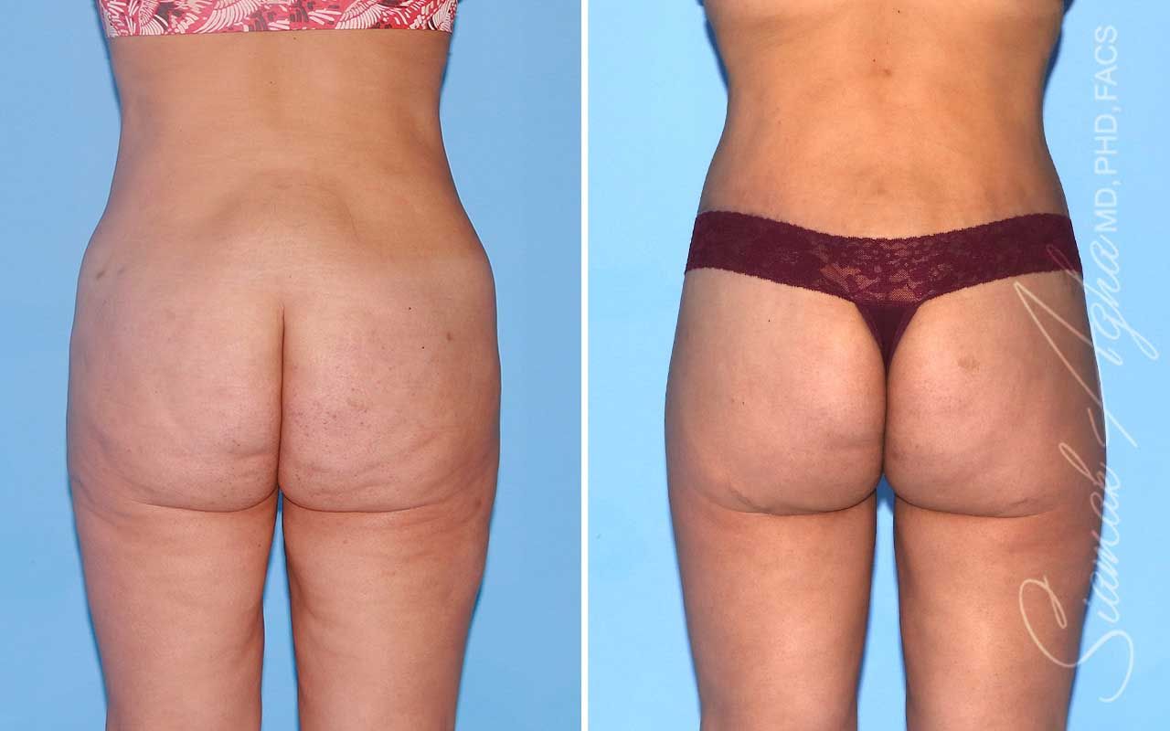 Lower Body Lift Before & After