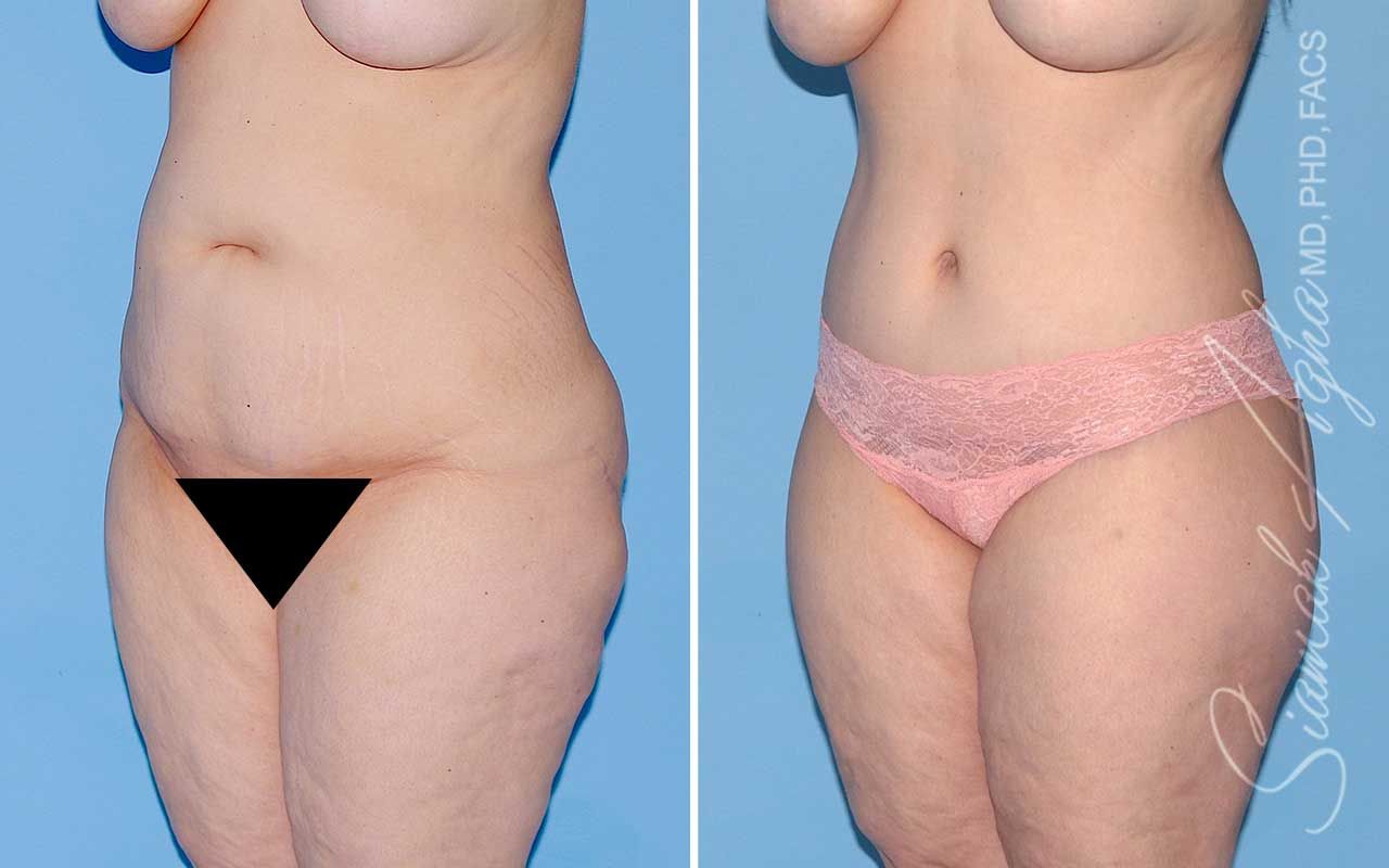 Lower Body Lift Before & After