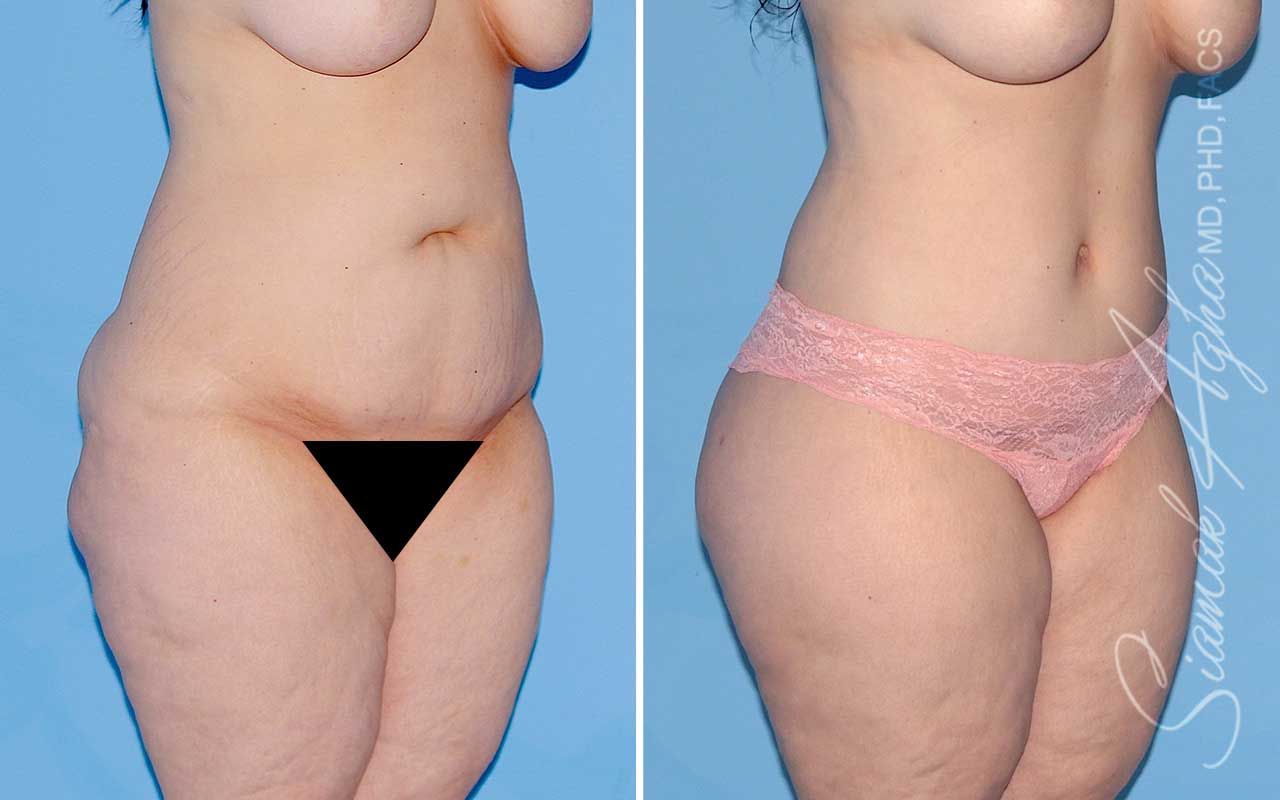 Lower Body Lift Before & After