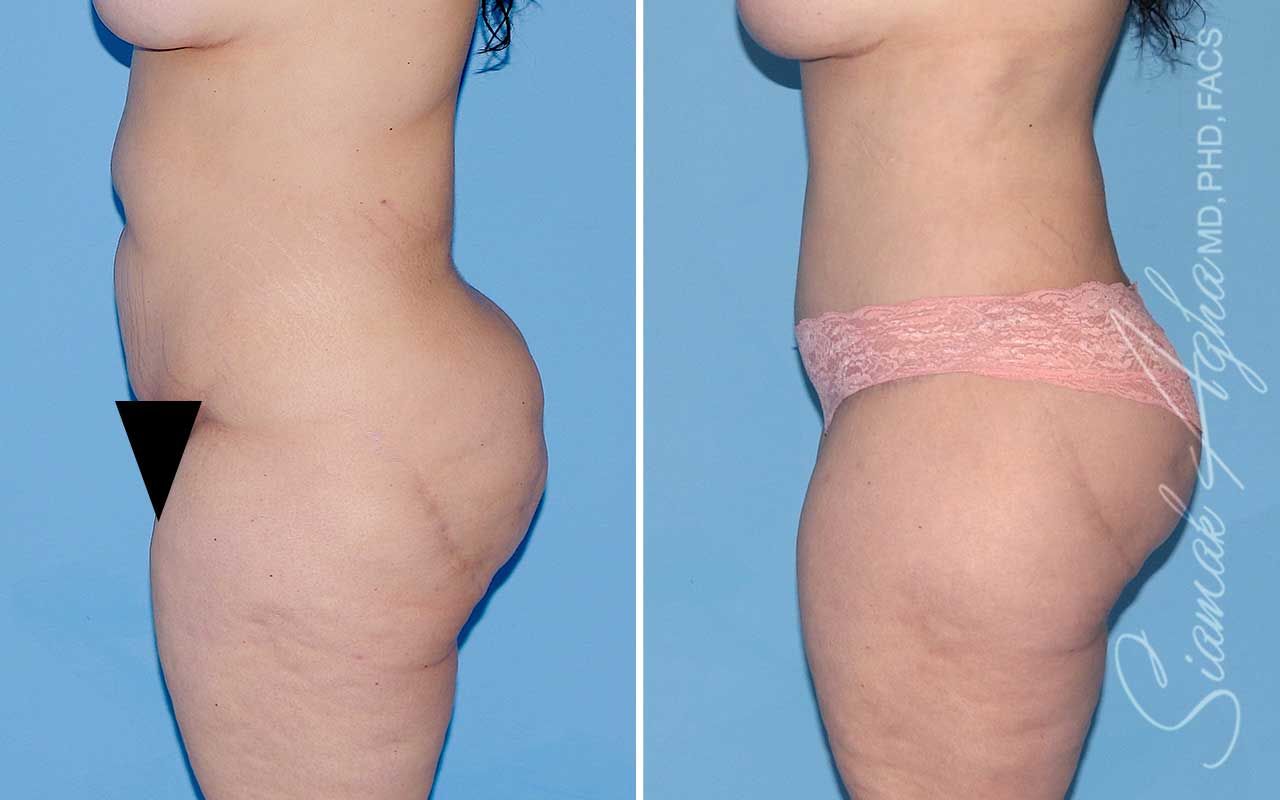 Lower Body Lift Before & After