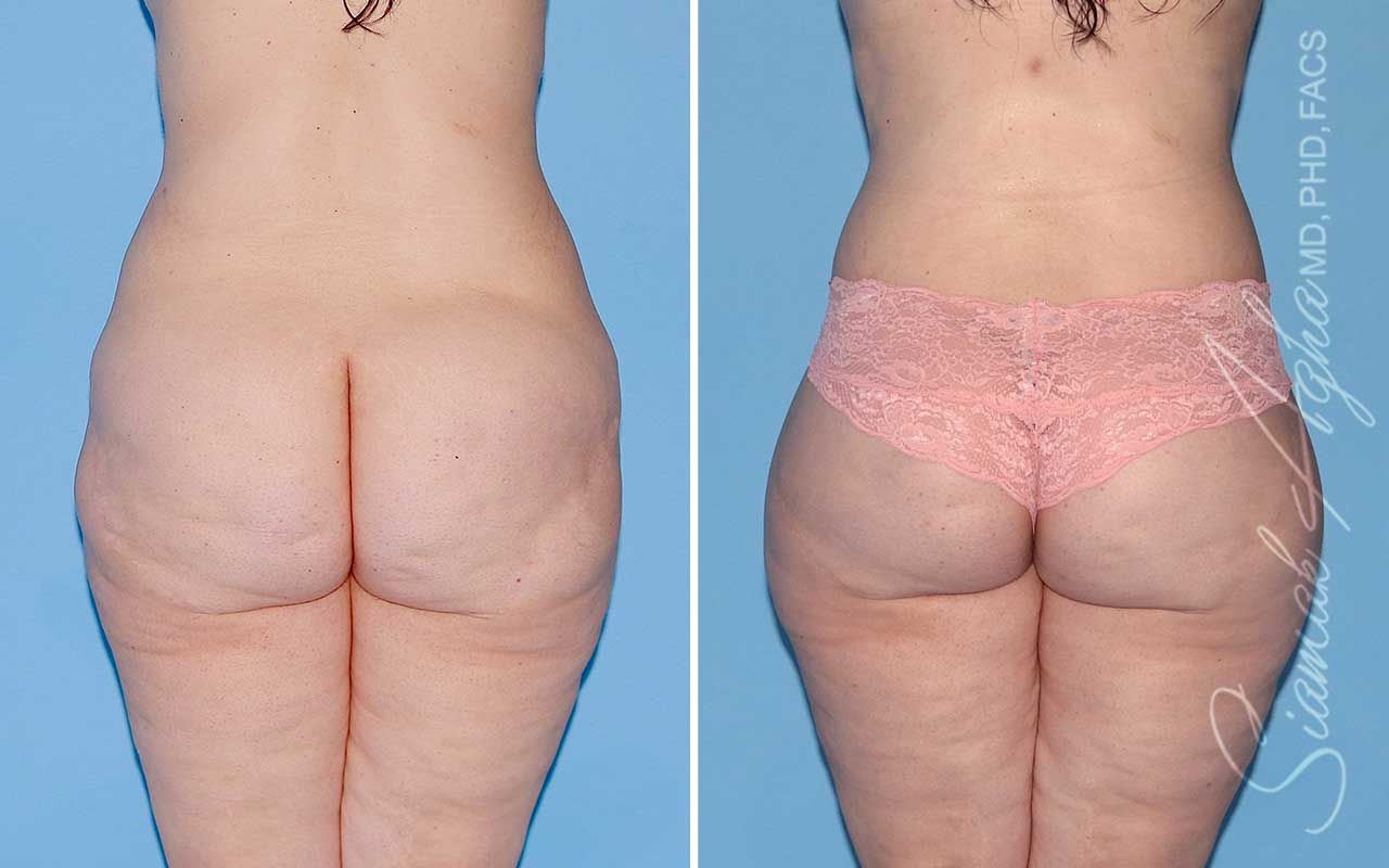 Lower Body Lift Before & After