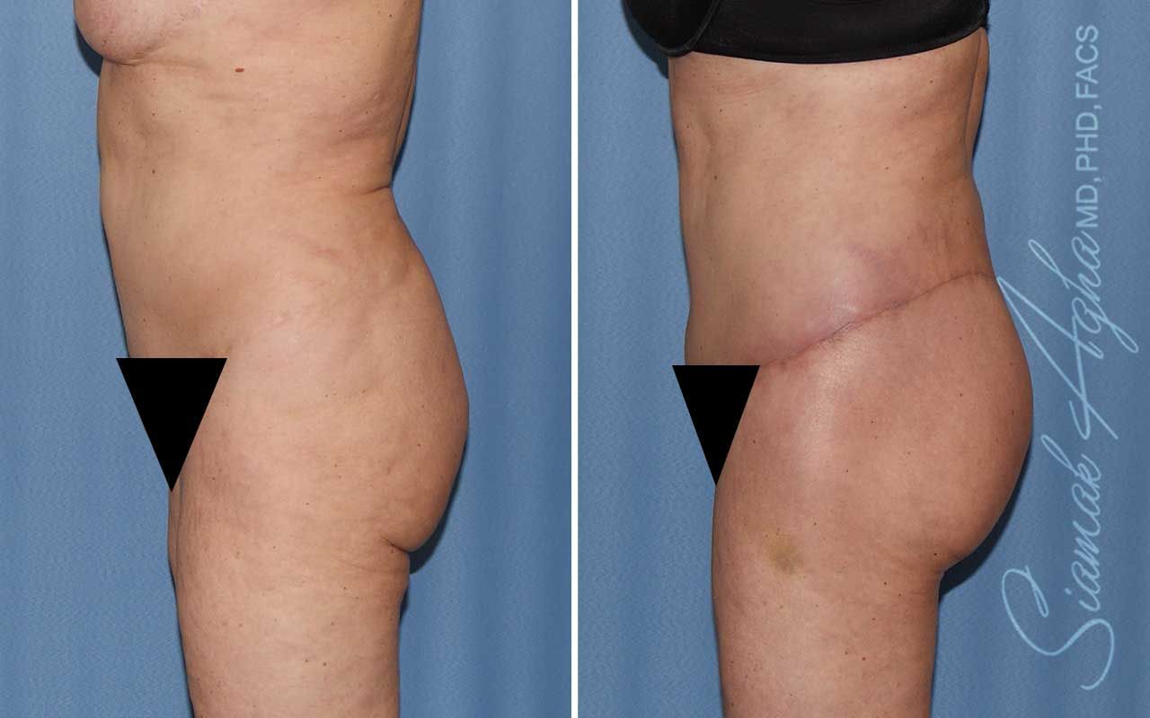 Lower Body Lift Before & After