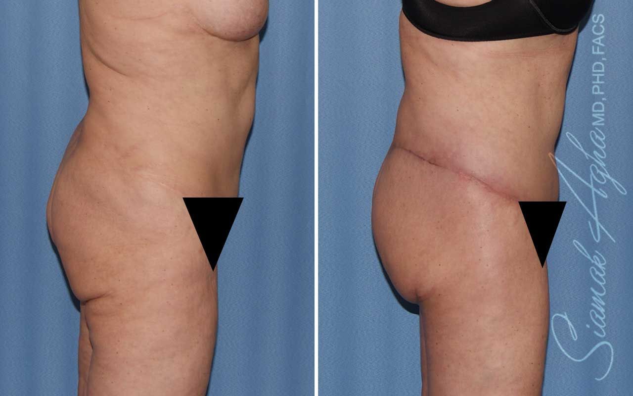 Lower Body Lift Before & After