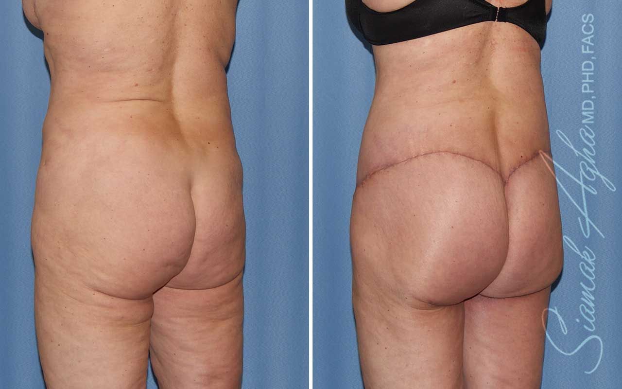 Lower Body Lift Before & After