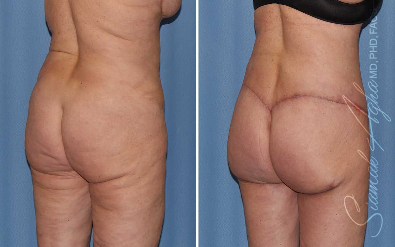 Lower Body Lift Before & After
