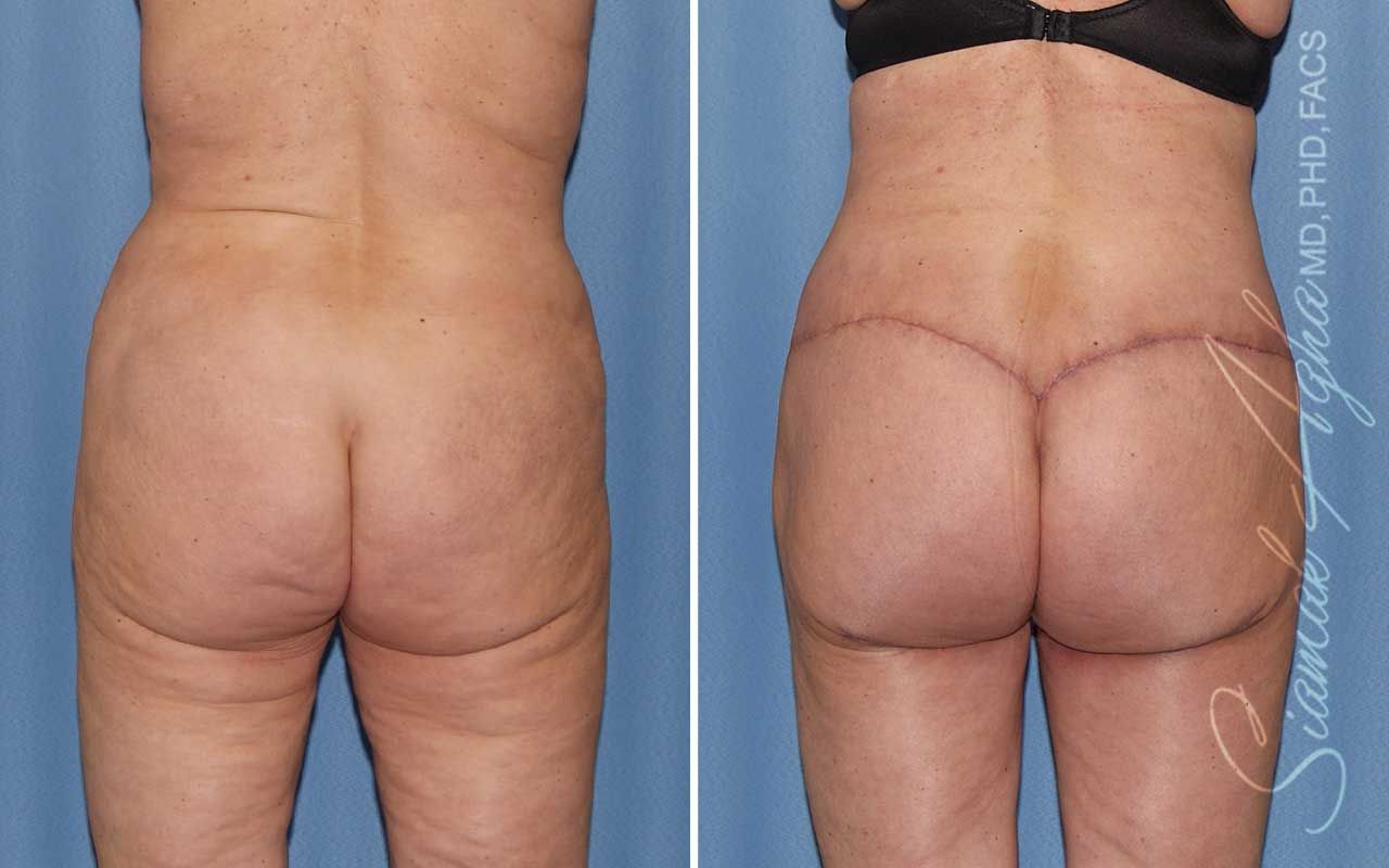 Lower Body Lift Before & After