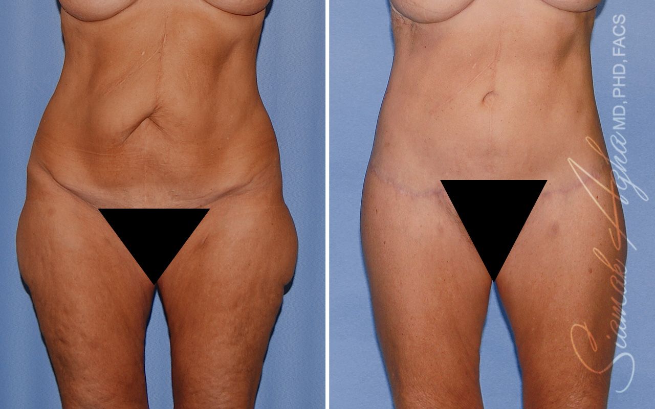 Lower Body Lift Before & After