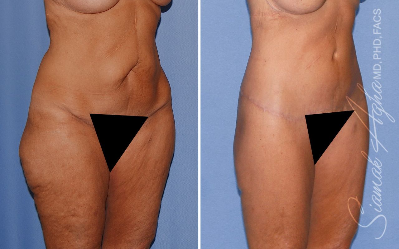 Lower Body Lift Before & After