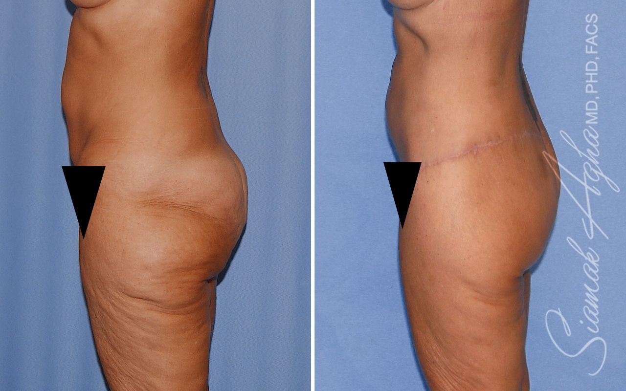 Lower Body Lift Before & After