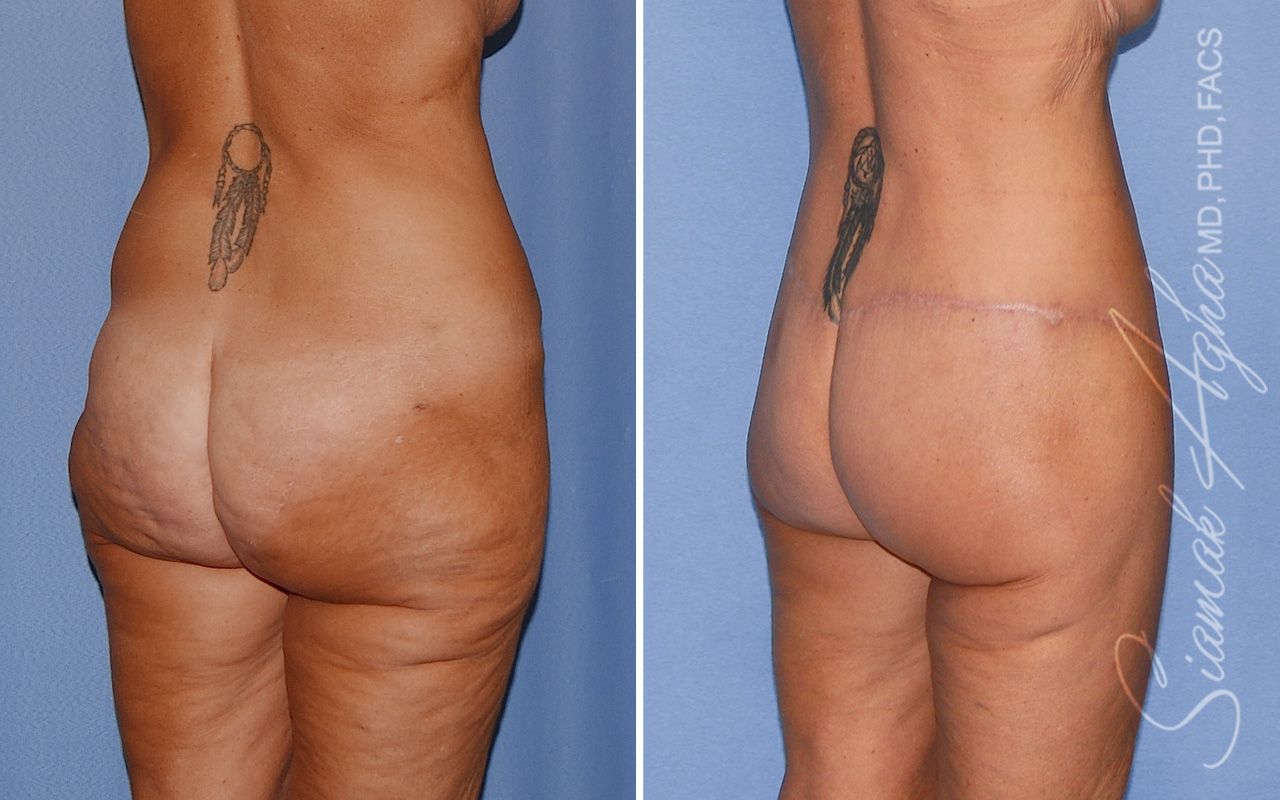 Lower Body Lift Before & After