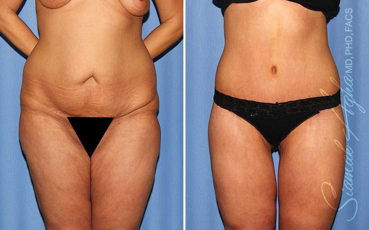 Lower Body Lift Before & After