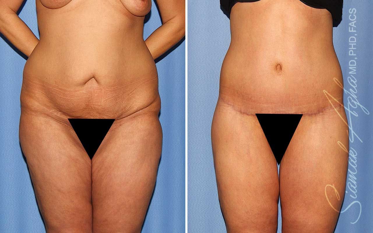 Lower Body Lift Before & After