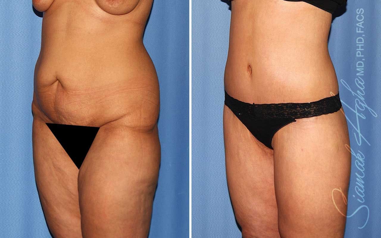 Lower Body Lift Before & After