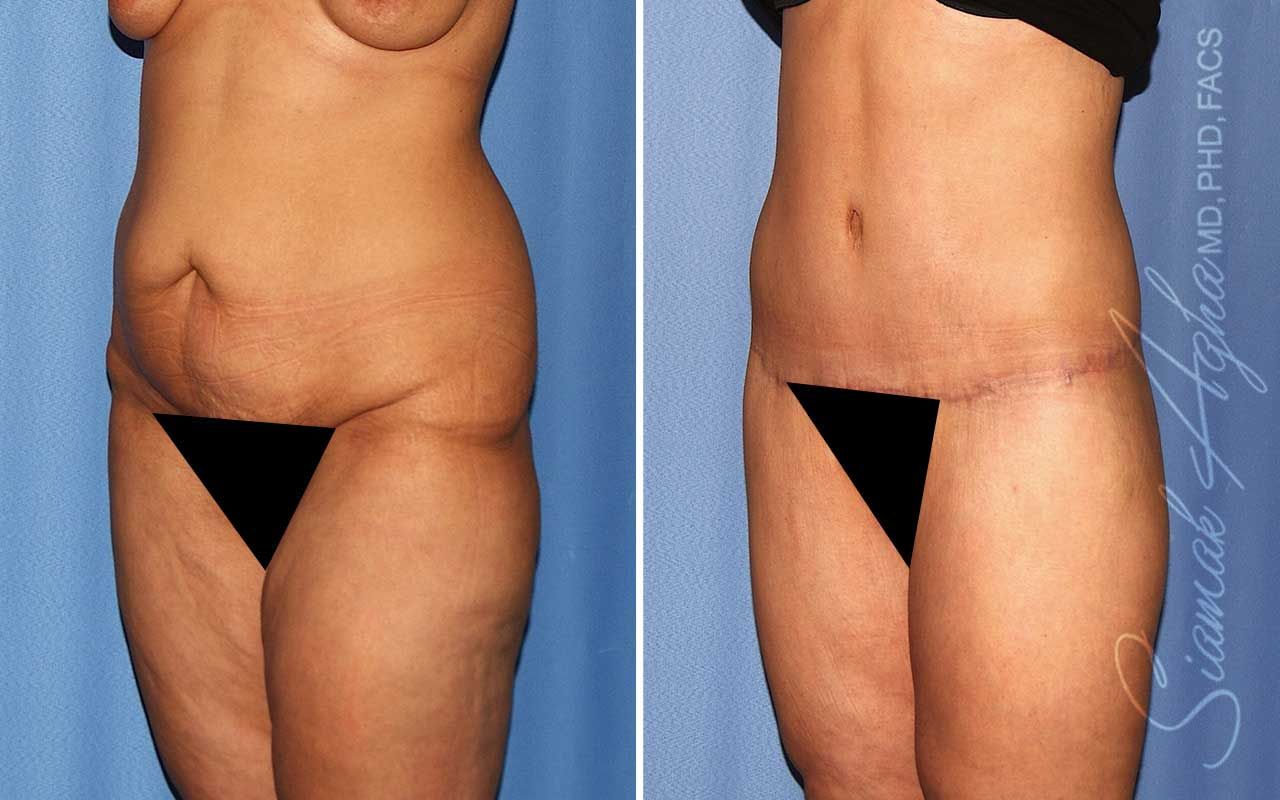 Lower Body Lift Before & After