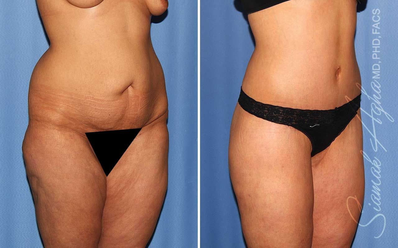 Lower Body Lift Before & After