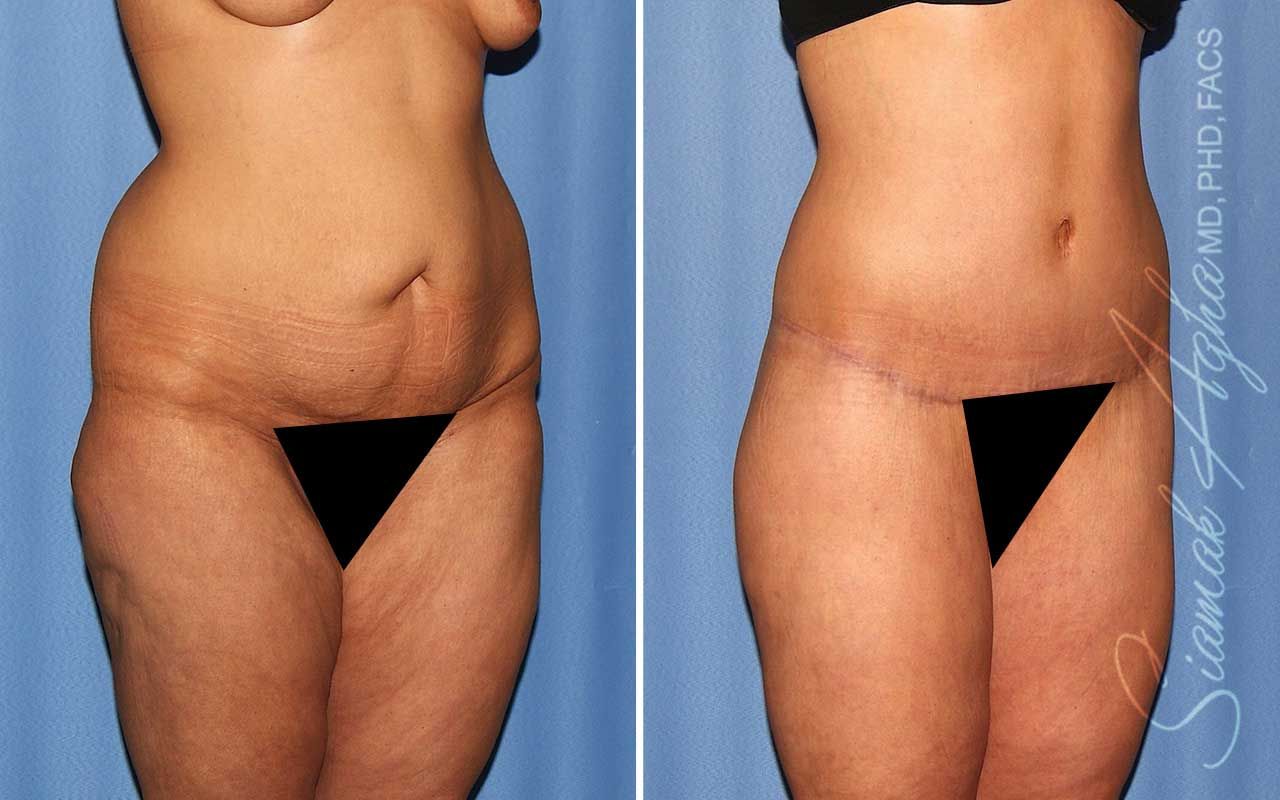 Lower Body Lift Before & After