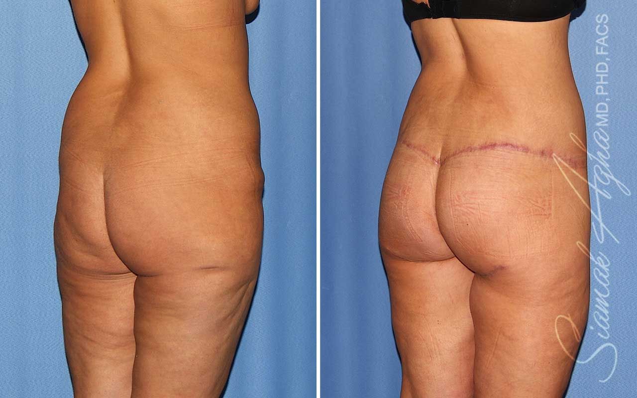 Lower Body Lift Before & After