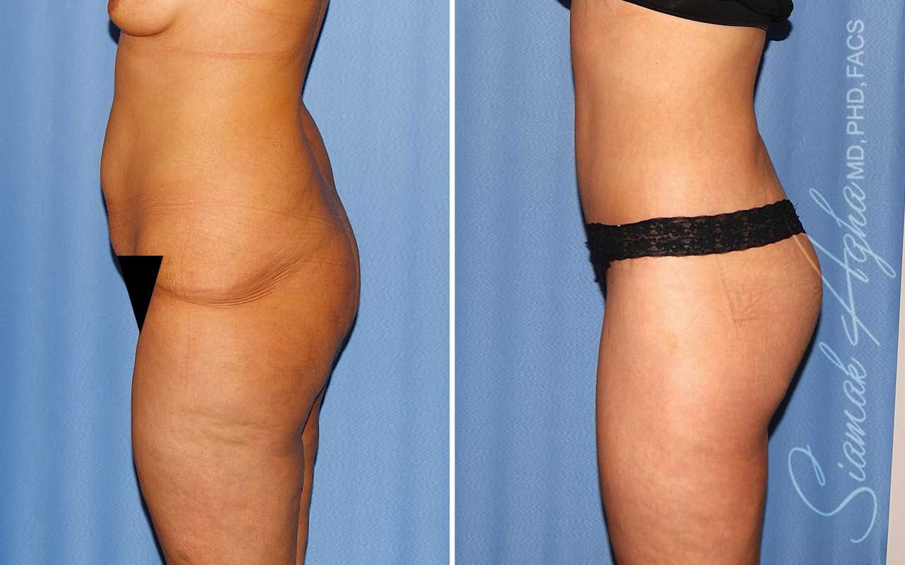 Lower Body Lift Before & After
