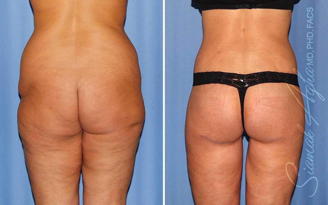 Lower Body Lift Before & After
