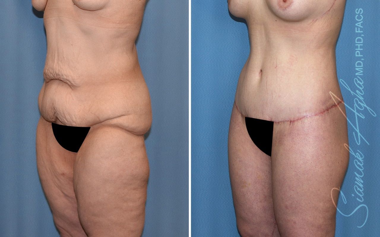 Lower Body Lift Before & After