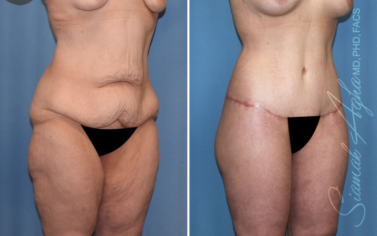 Lower Body Lift Before & After