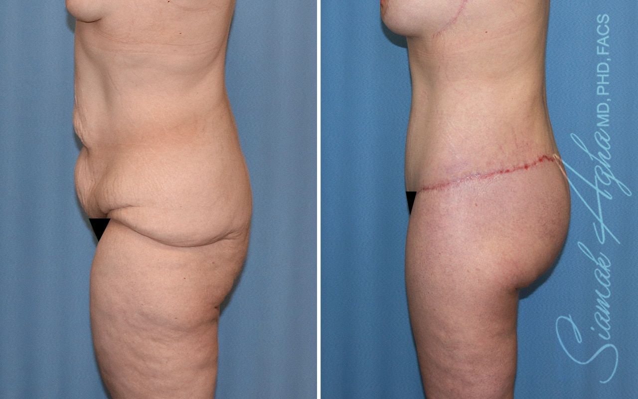 Lower Body Lift Before & After