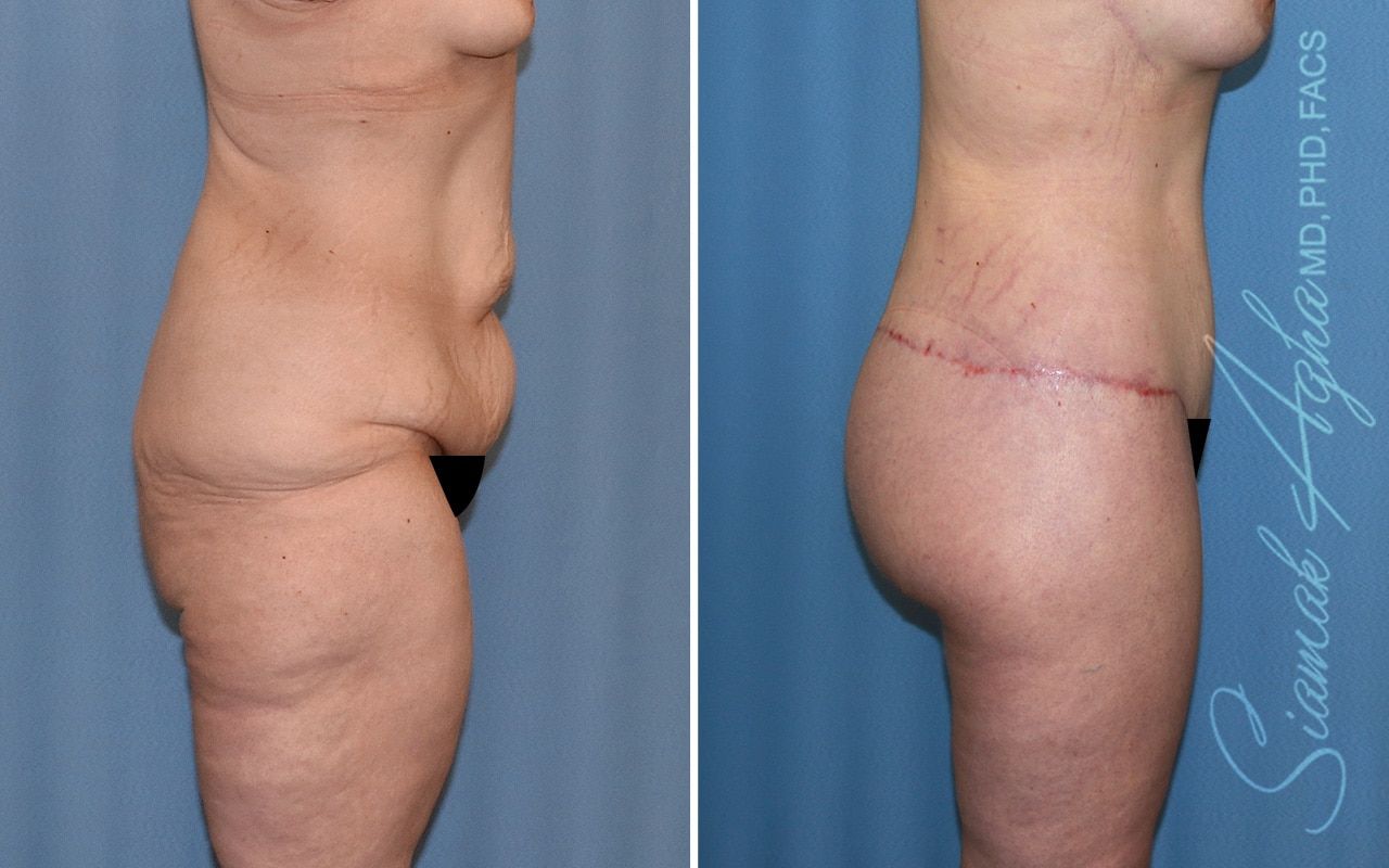 Lower Body Lift Before & After