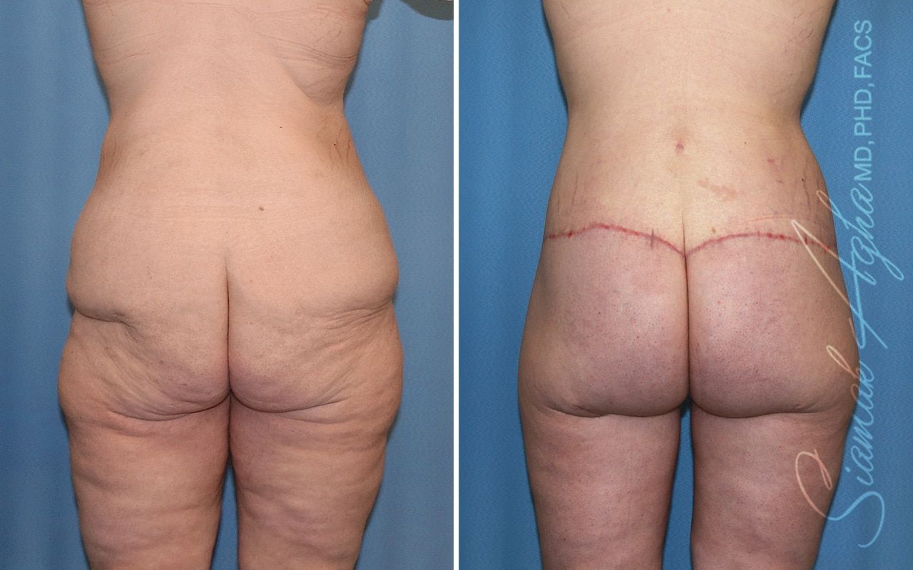 Lower Body Lift Before & After